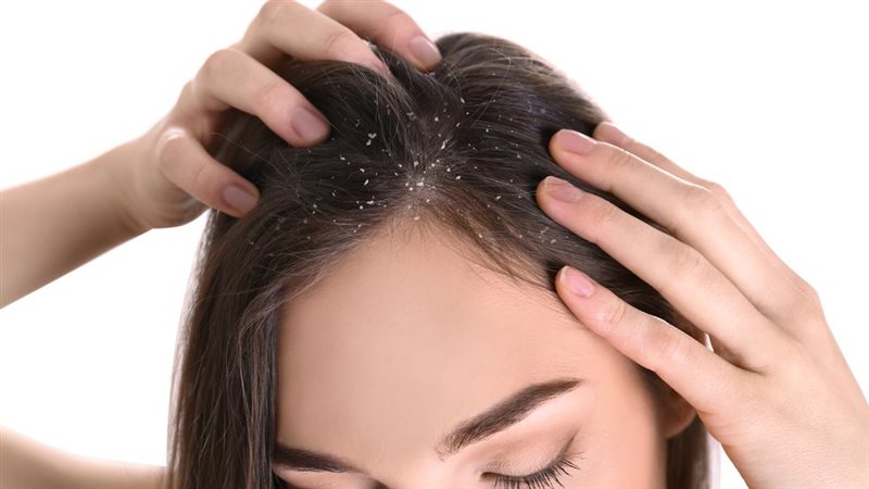علاج قشرة الرأس