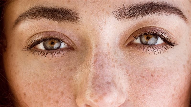 طرق التخلص من النمش