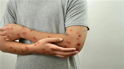 أعراض الجديري المائي وأسبابه وطرق العلاج 