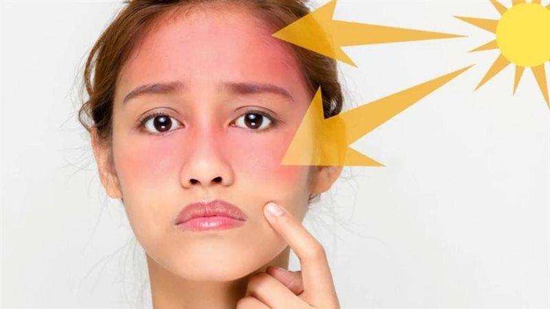 علاج حروق الشمس