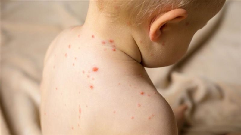 علاج حمو النيل، فيتو