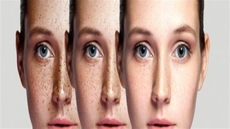 طرق التخلص من النمش،
