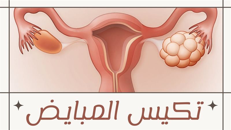 تكيسات المبايض