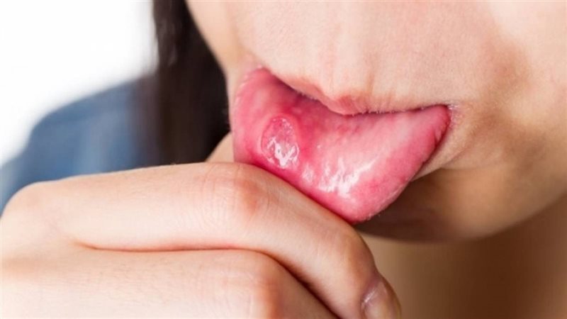 علاج قرح الفم بمواد