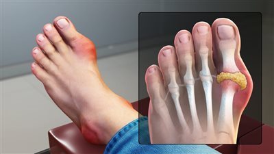 أعراض النقرس وأسباب الإصابة به وطرق العلاج 