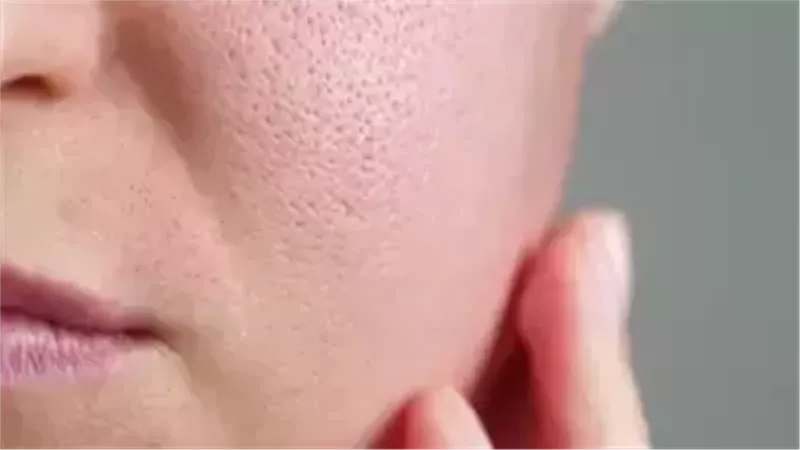 المسام الواسعة، فيتو