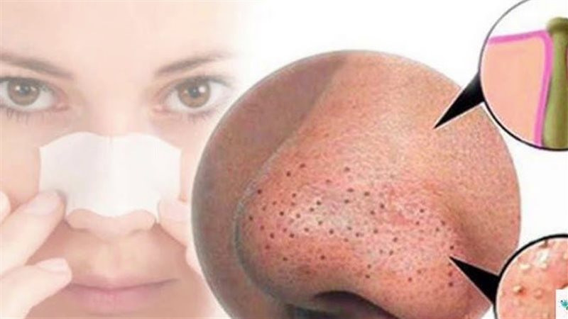 علاج الرؤوس السوداء،