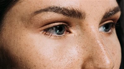 أسباب ظهور النمش بالبشرة وطرق علاجه 