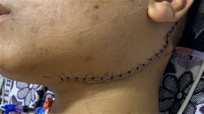 أطباء الفيوم العام ينجحون في إنقاذ شاب من موت محقق (صور)