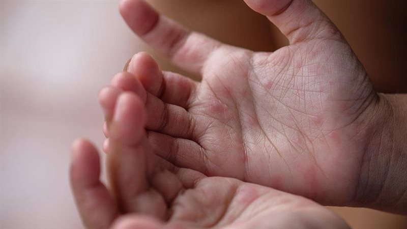 طرق الوقاية من مرض