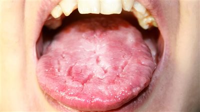  6 نصائح لعلاج فطريات اللسان عند الكبار والصغار 