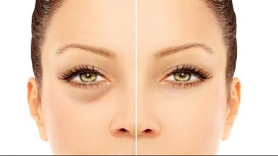 طرق بسيطة تخلصك من الانتفاخات حول العينين 