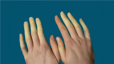استشارى قلب، ظاهرة رينود تصيب النساء فقط فى الشتاء