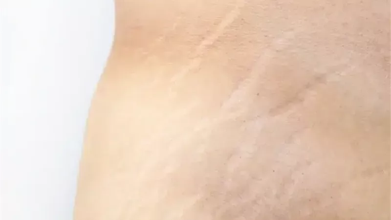 علامات التمدد بالجلد،