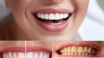 أسرار تبييض الأسنان في البيت بمكونات طبيعية وآمنة