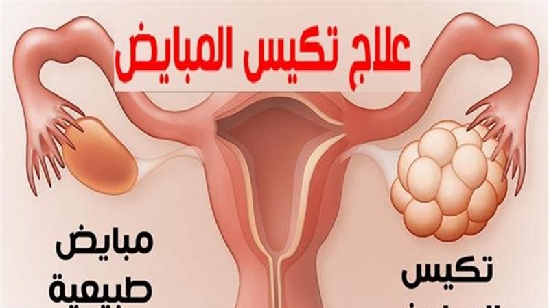 علاج تكيسات المبايض