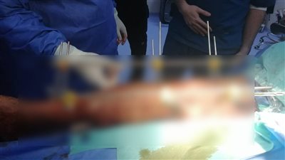 جراحة دقيقة استغرقت 7 ساعات، إنقاذ ساق مسن بمستشفى الفيوم العام 