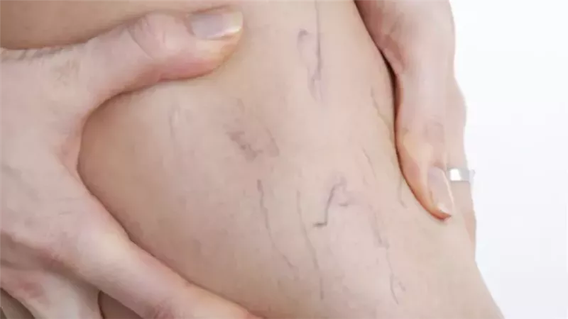 دوالي الساقين، فيتو