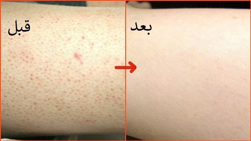 علاج جلد الوزه