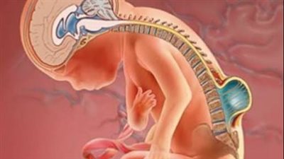 مرض الصلب المشقوق.. أسبابه ومضاعفاته وطرق علاجه