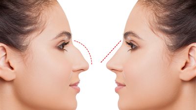 تعليمات مهمة لفترة النقاهة بعدعملية تجميل الأنف