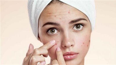 أسباب ظهور حبوب الوجه.. ووصفات طبيعية للعلاج السريع