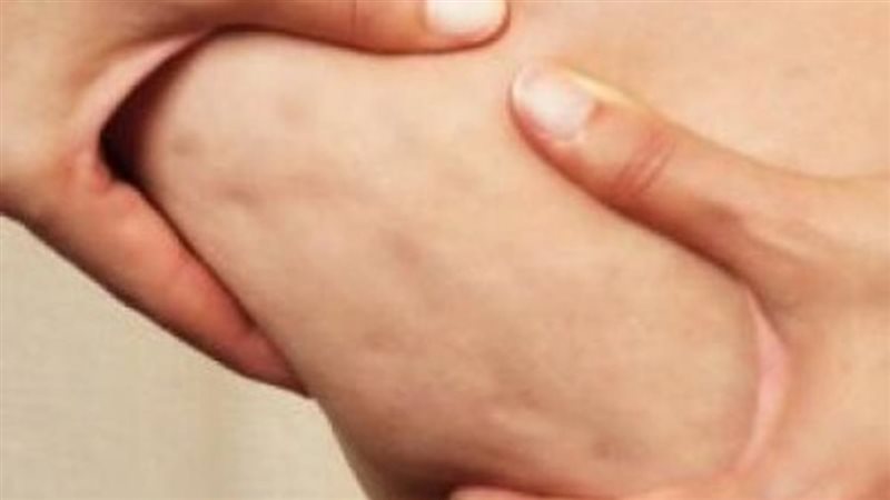 وصفات لعلاج السيلوليت