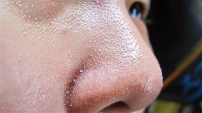 طرق آمنة للتخلص من البثور البيضاء بالبشرة 