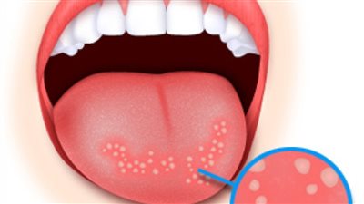 أسباب وأعراض الفطريات في الفم وعلاجها بالمواد الطبيعية