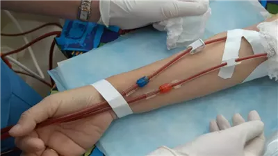 هل يمكن تأخير الغسيل الكلوي؟ استشاري يجيب 