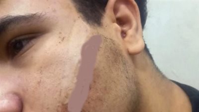 إصابة طالب في مشاجرة عقب الامتحان بشبرا الخيمة ومديرية التعليم تفتح تحقيقًا موسعًا