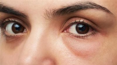 طرق علاج انتفاخ العينين.. ومتى يجب اللجوء إلى الطبيب؟