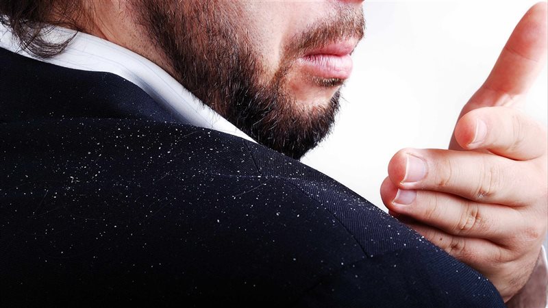 علاج قشرة الشعر