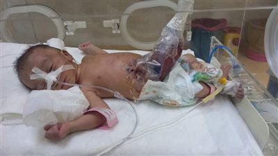 وحدة العلاج عن بعد تنقذ حياة رضيع ولد بإمعاء خارج البطن في الوادى الجديد | صور