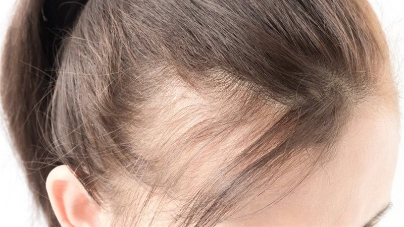طرق انبات الشعر