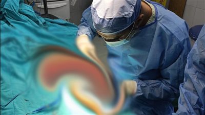 مستشفى الضبعة يجري عملية دقيقة لطفلة مصابة بشلل لأول مرة |صور