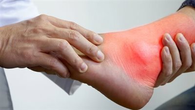 مرض النقرس.. الأعراض والأسباب وطرق العلاج بالأطعمة الطبيعية 