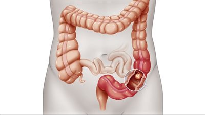 أعراض انسداد الأمعاء.. كل ما تريد معرفته عن الانسداد المعوي
