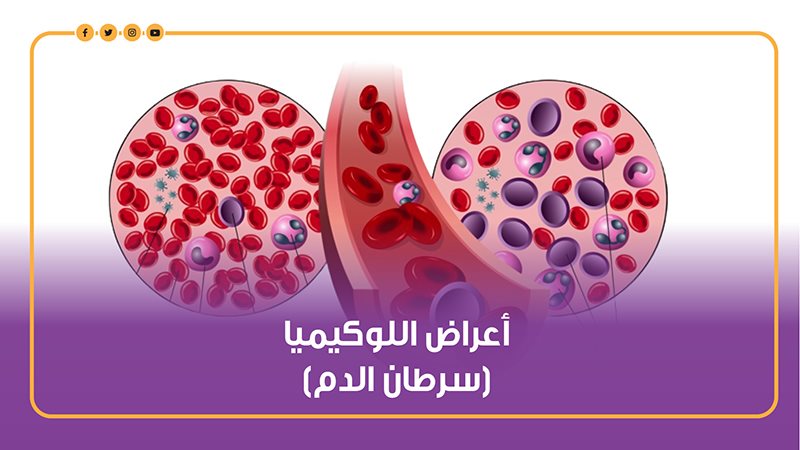 سرطان الدم