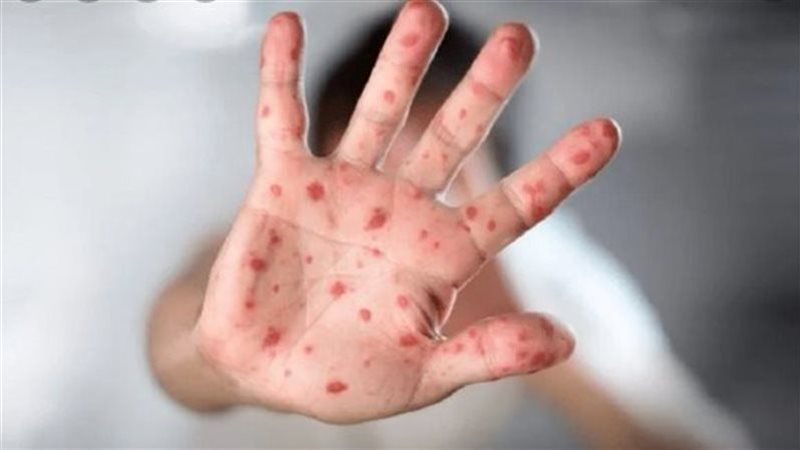 جدري القرود