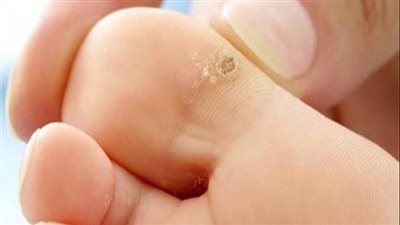 علاج عين السمكة، روشتة من الدكتور هاني الناظر بدون كي كهربائي أو ليزر