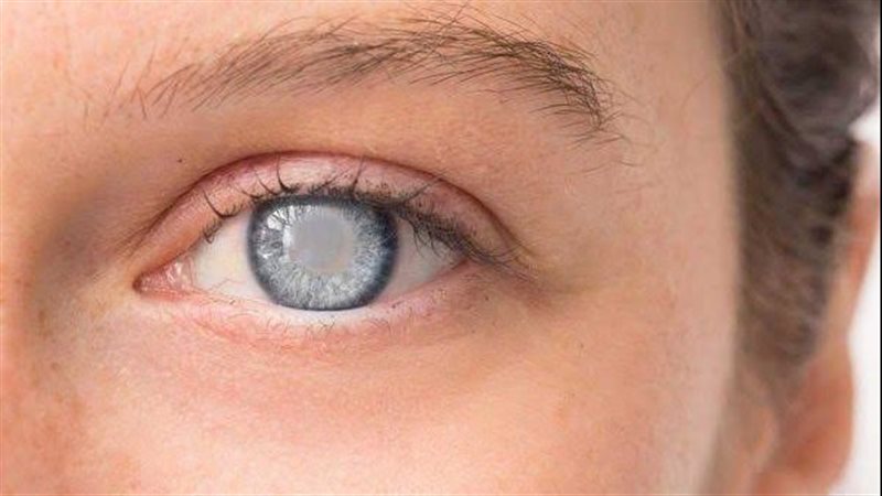 عمليات المياه البيضاء