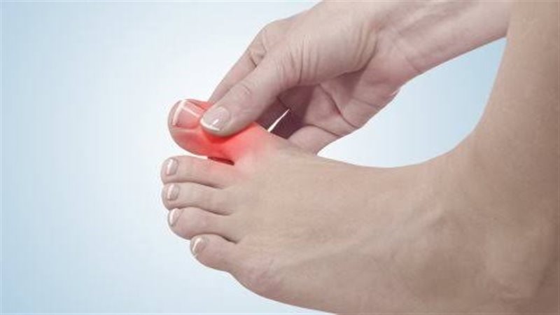 مرض النقرس