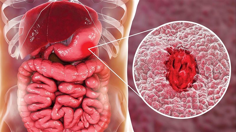 اعراض جرثومة المعدة