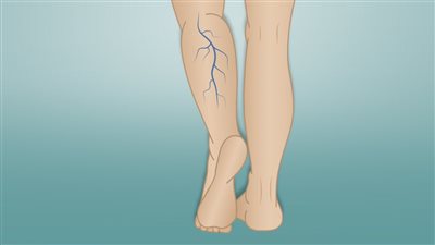 تعرف على علاج الدوالي وأسباب الإصابة وأعراضها