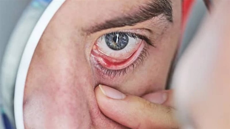 أمراض العيون 