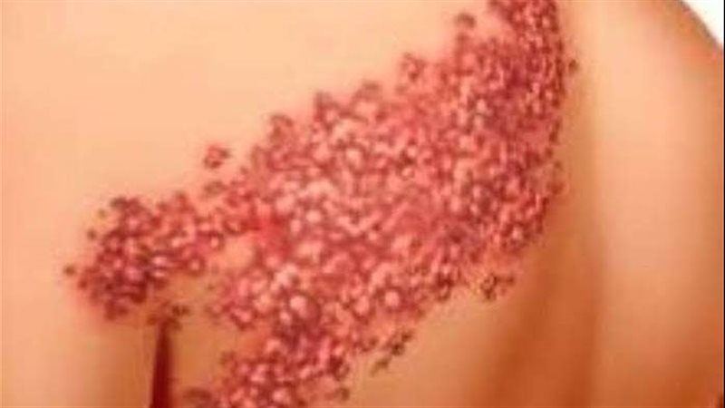 مرض الحزام الناري
