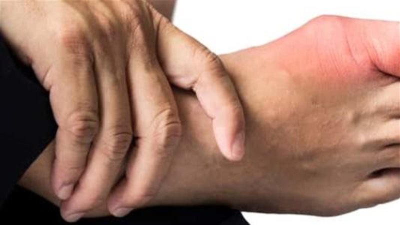 اعراض النقرس